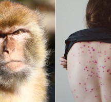 ماهو مرض جدري القرود
