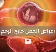 اعراض الحمل خارج الرحم