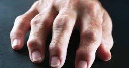 اعراض الروماتويد