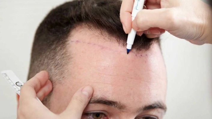 زراعة الشعر في السعودية 2022