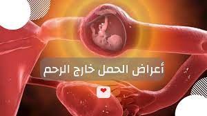 اعراض الحمل خارج الرحم