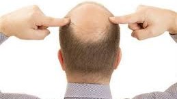 علاج الصلع الوراثي